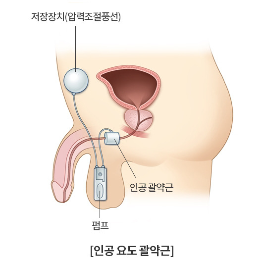 중년 요실금의 원인 및 증상, 치료방법
