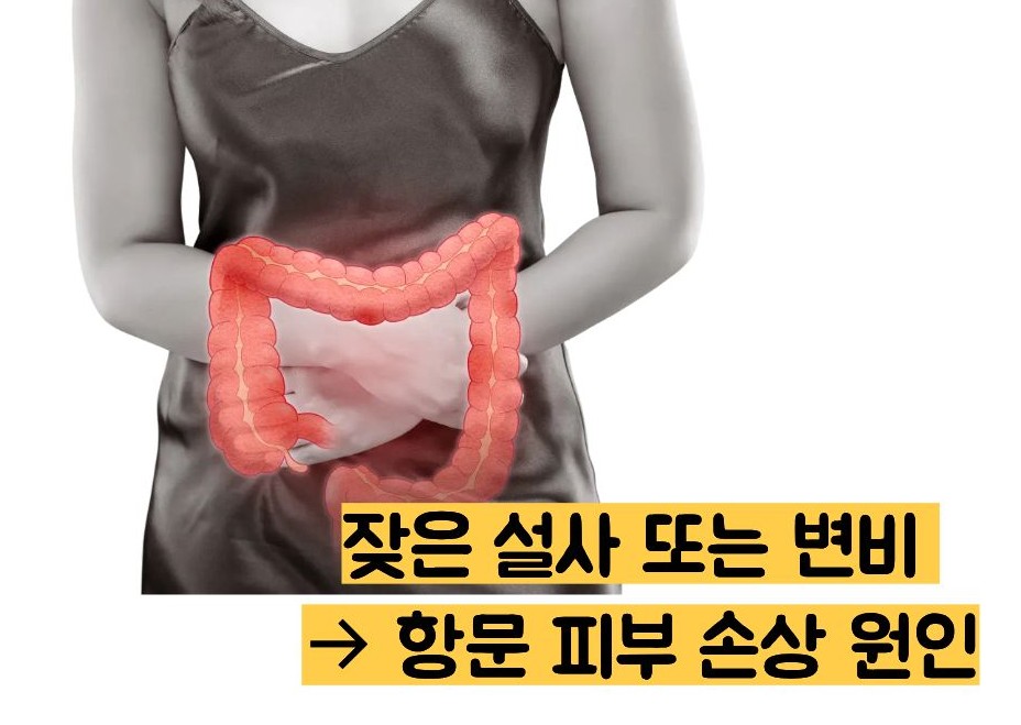 똥꼬가 가려운 이유
