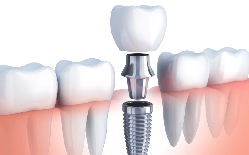 임플란트 종류 시술과정 및 임플란트 후 교정 김태희 수지 효과