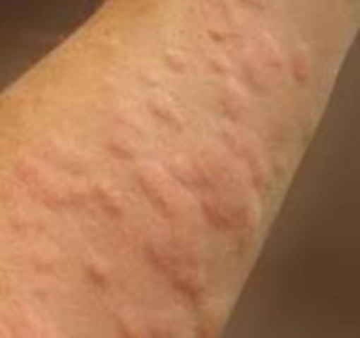 콜린성 알레르기 이미지