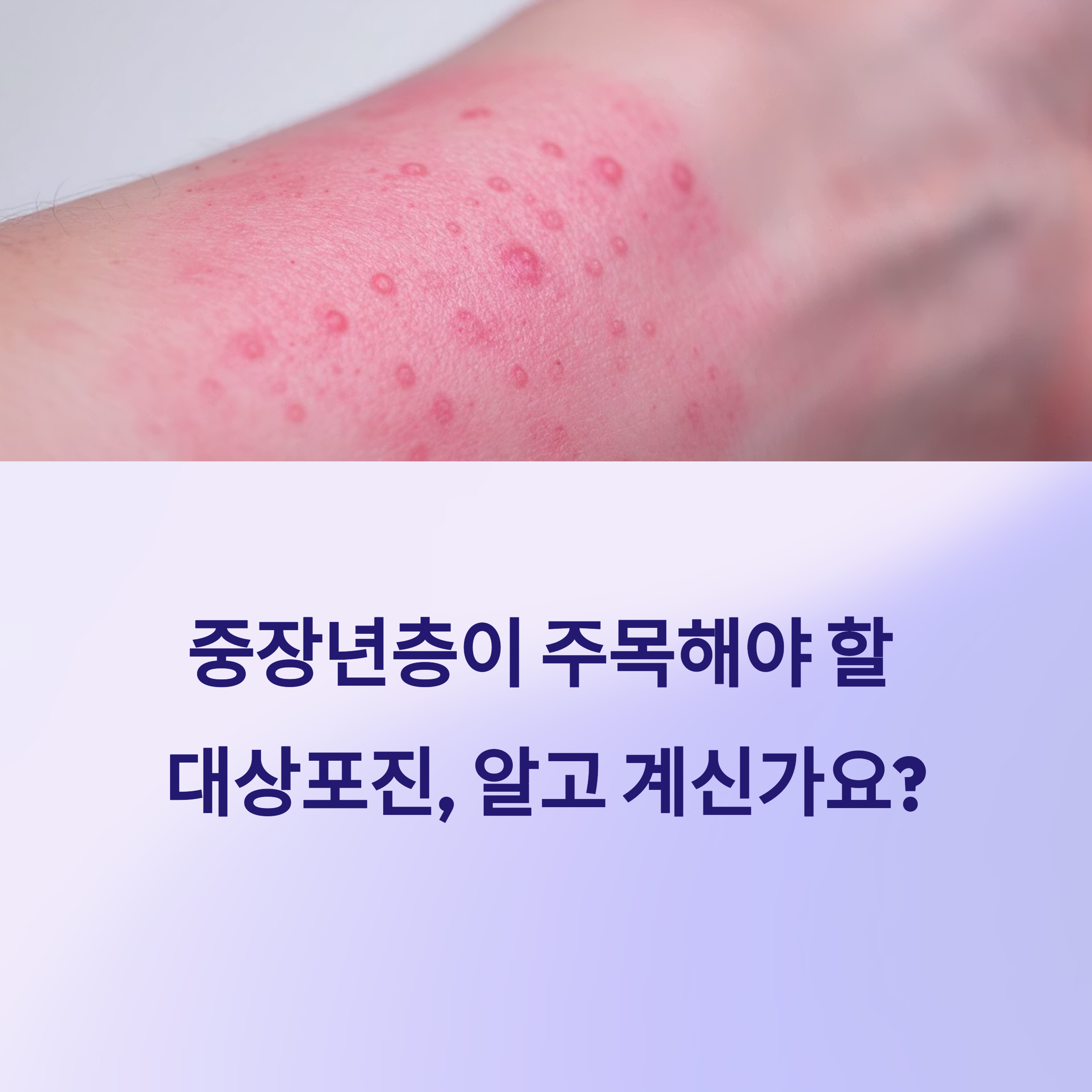 대상포진 예방접종과 가격