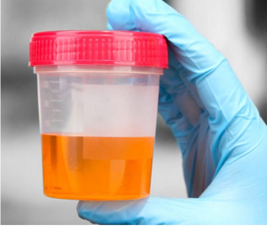 소변 색깔이 노란색