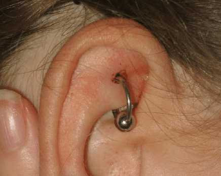 귀뚫은 곳 염증