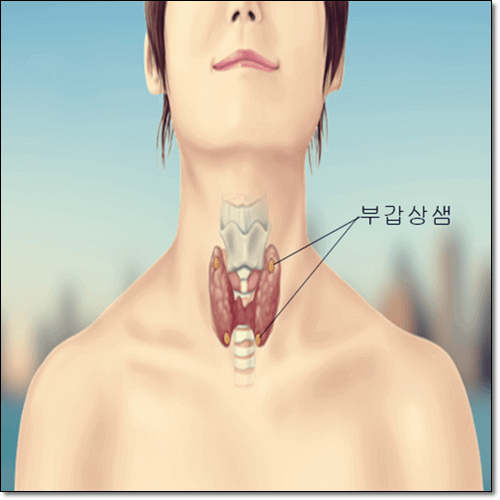 부갑상선기능항진증 증상