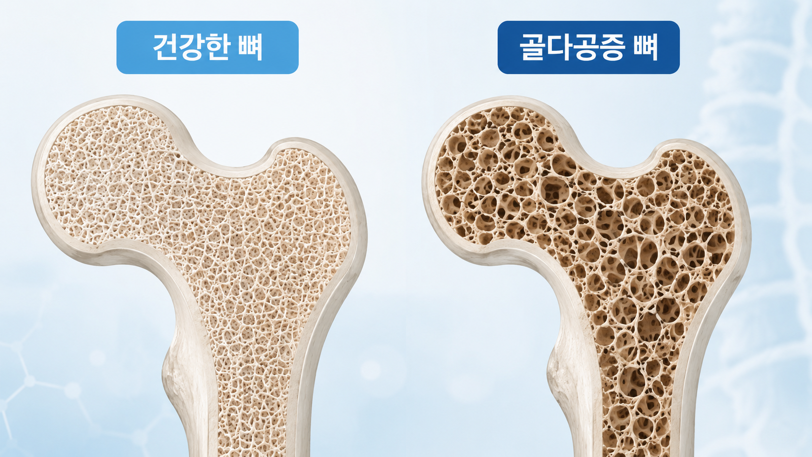 키가 줄고 잘 삐끗한다면, 골다공증 신호일 수 있습니다