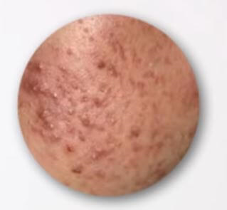 여드름 붉음증 예시