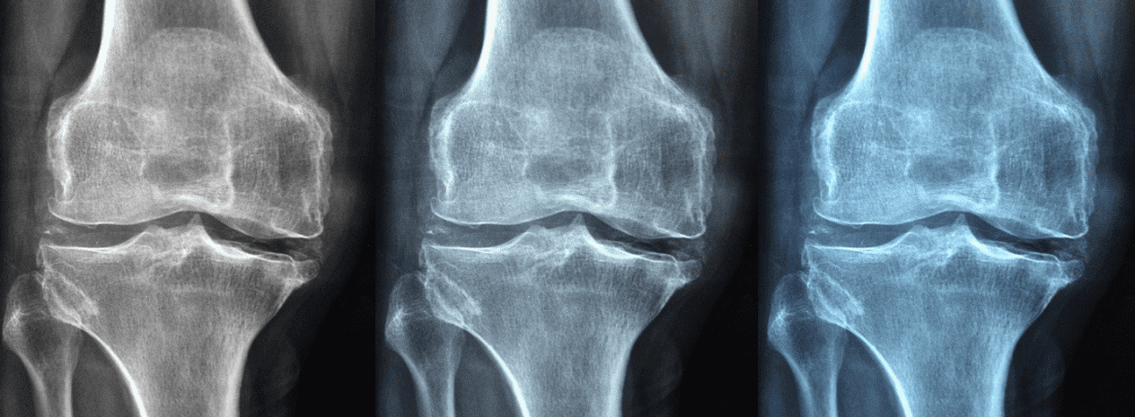 골다공증에 좋은 음식, 운동