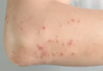 대상포진-예방접종-무료-가격-종류-건강