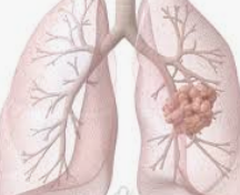 폐결핵 원인