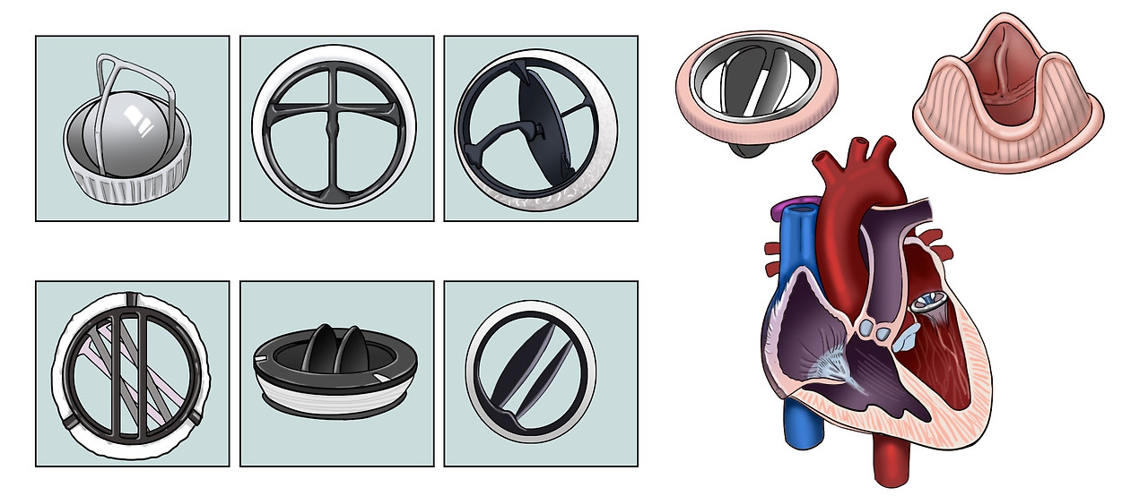 인공판막 치환술 수술 입원기간