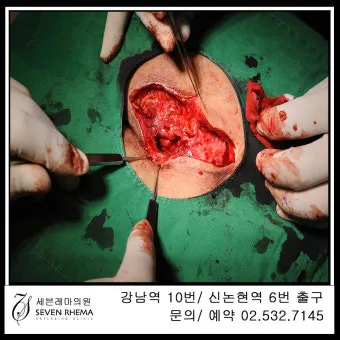 엉덩이 종기가 생기는 이유 왜 생기고 어떻게 관리할까요 완벽 가이드_19