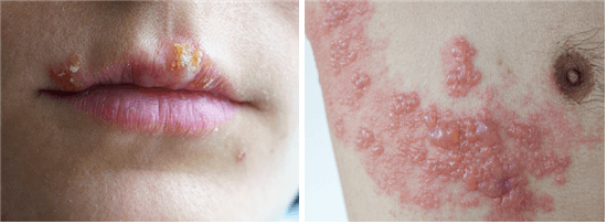 대상포진 초기증상