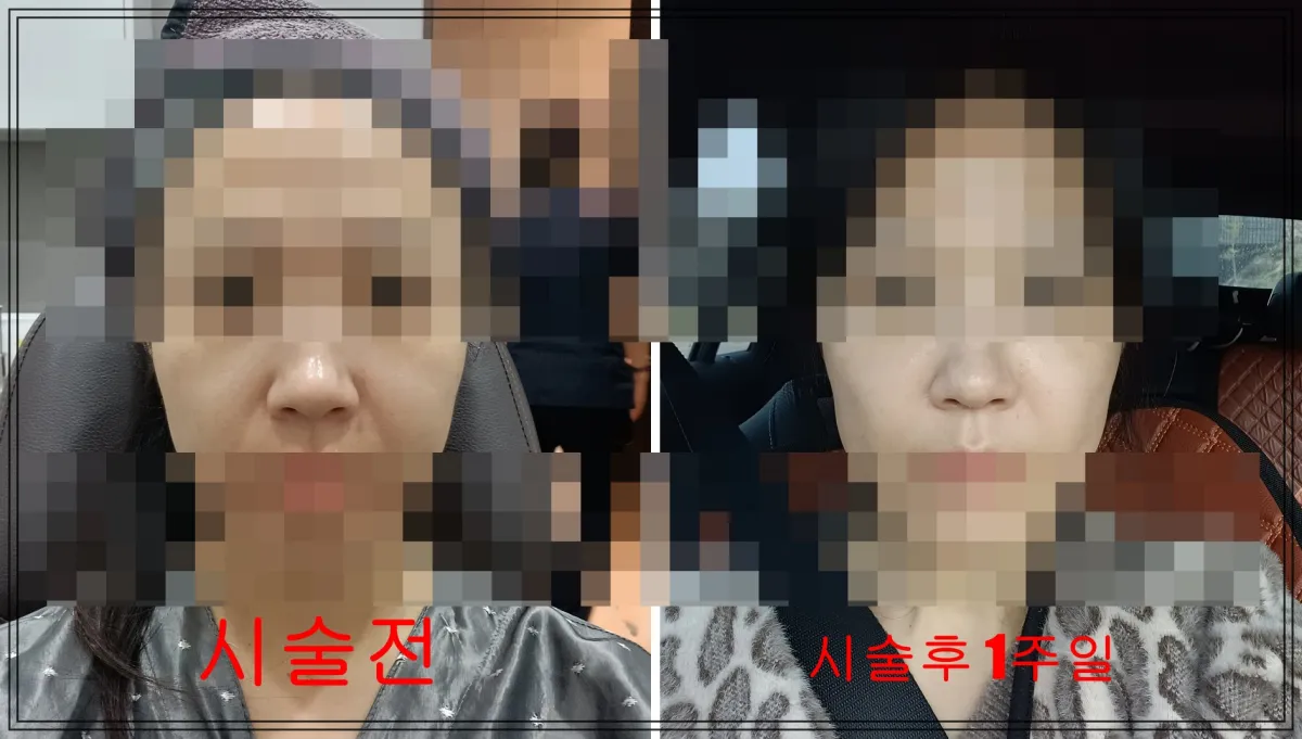 써마지-시술전-일주일후-변화