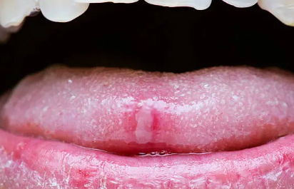 혓바늘 돋는 이유 및 없애는 법 (+ 약 치료법 꿀)