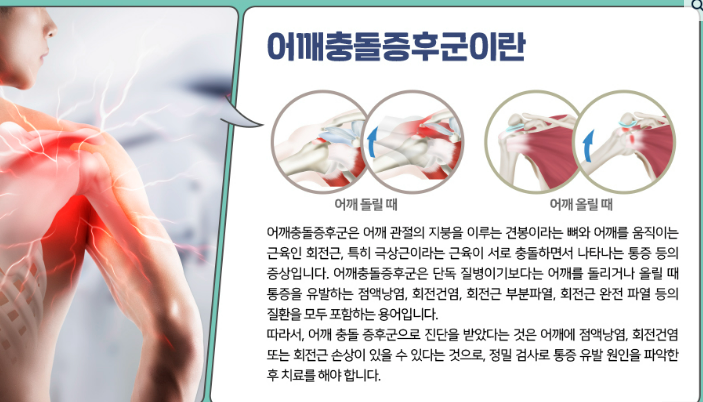 어깨 통증 원인