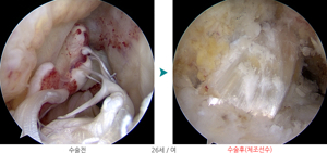 무릎십자인대파열