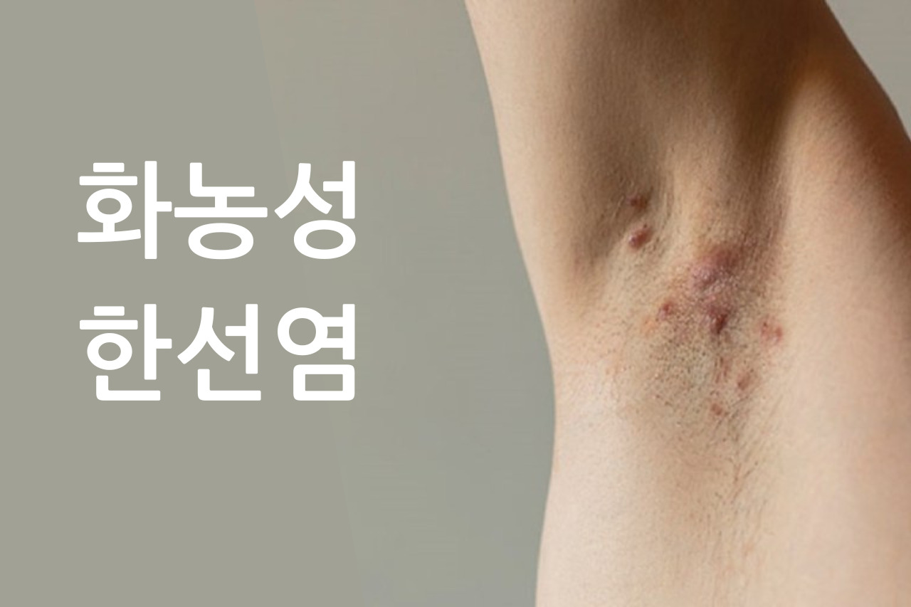 화농성 한선염 가이드: 증상, 원인, 최신 치료법