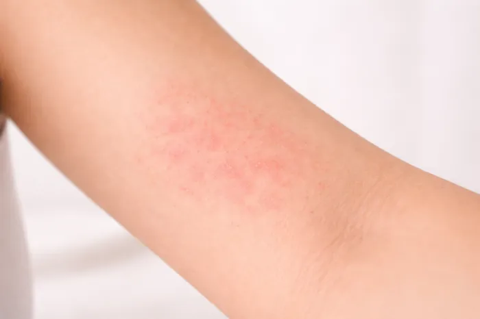 피부에 붉은반점이 생기는 이유