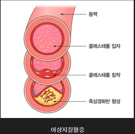 혈관에 지방으로 막혀 있는 모습