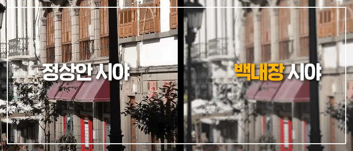 백내장 증상