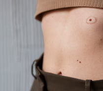 피부암 초기증상 16