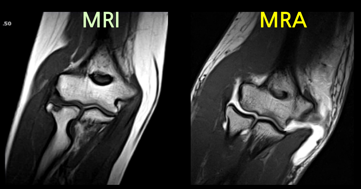 Elbow-MRI-MRA