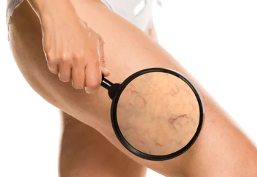 하지 정맥류 증상