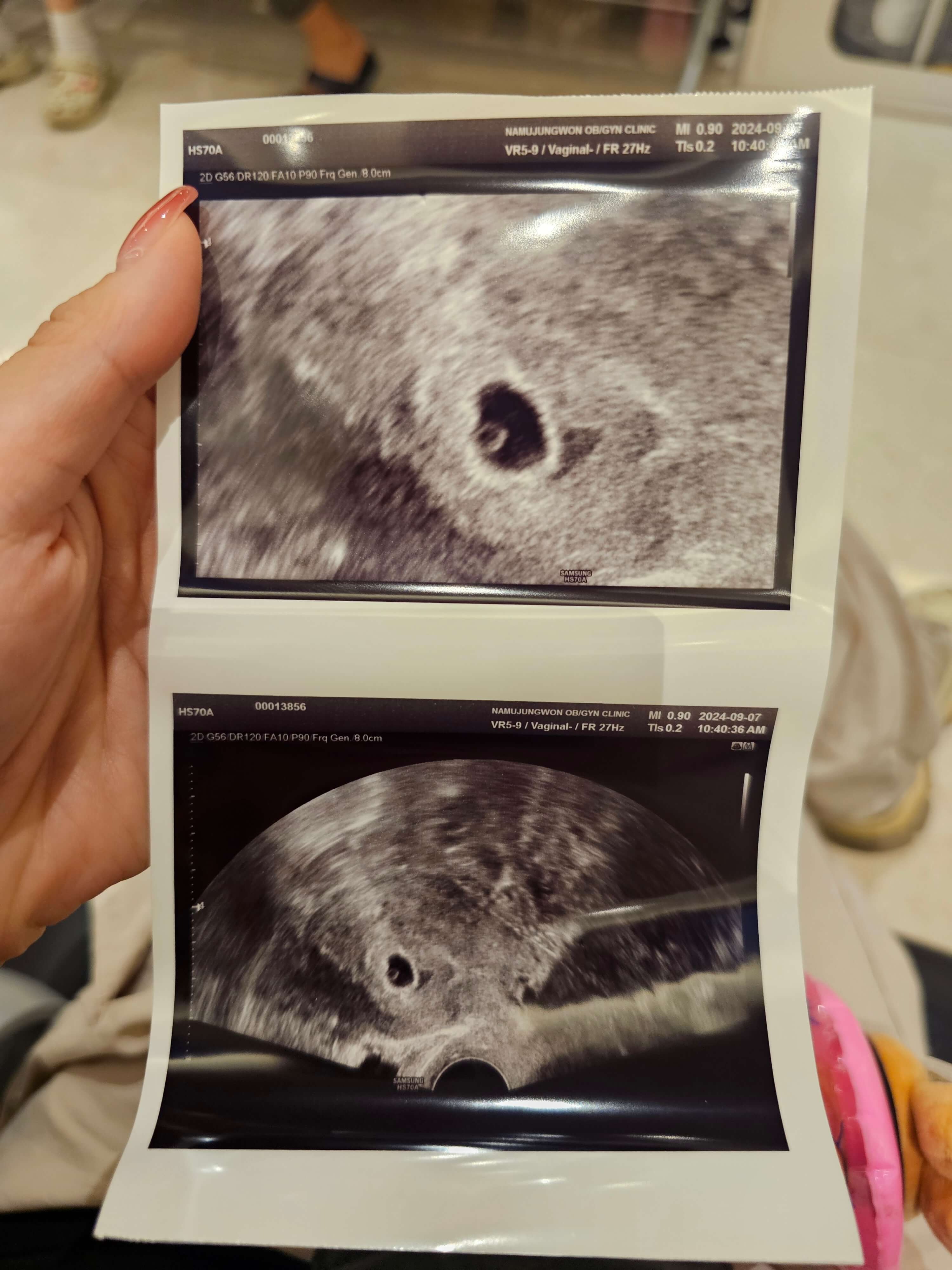 아기집-확인-임신확인서