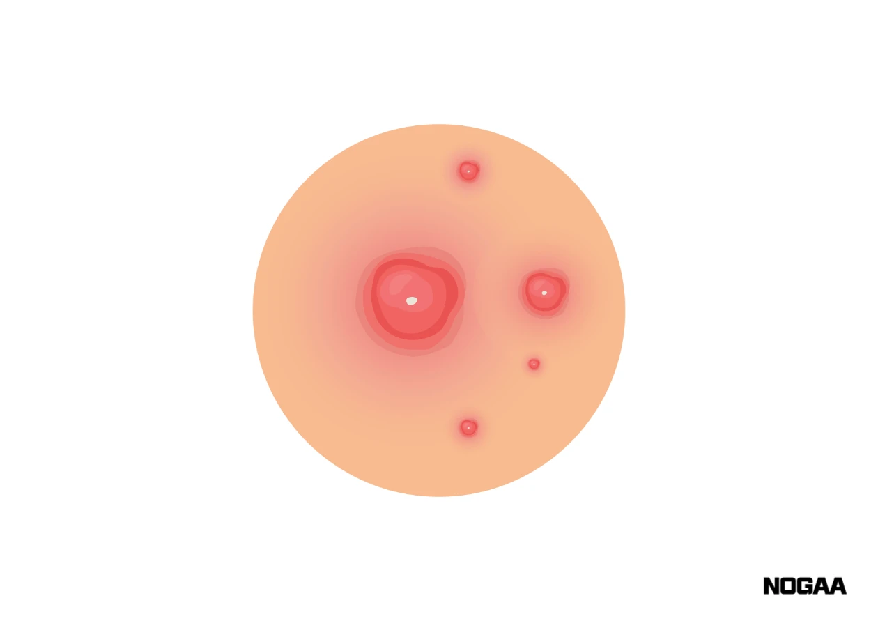 모공각화증 치료 방법