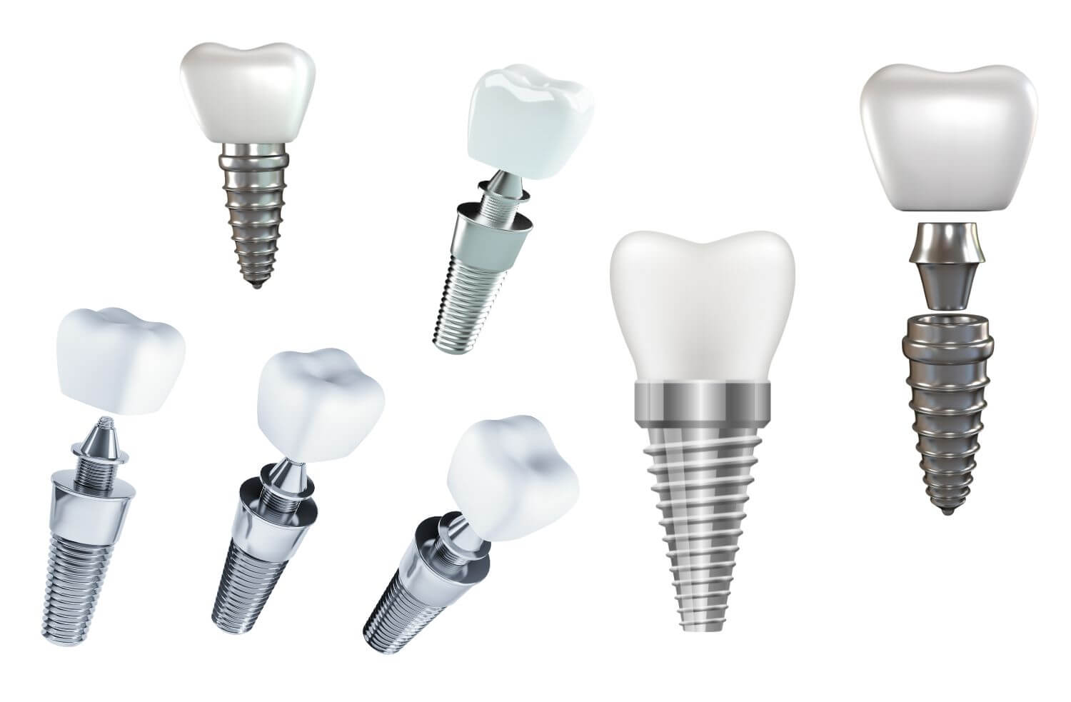 임플란트 종류 (오스템, 덴티움, 아스트라, 네오)