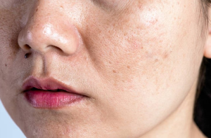 기미 레이저 후 붉음증이 오래가는 이유와 사후 관리 체크리스트