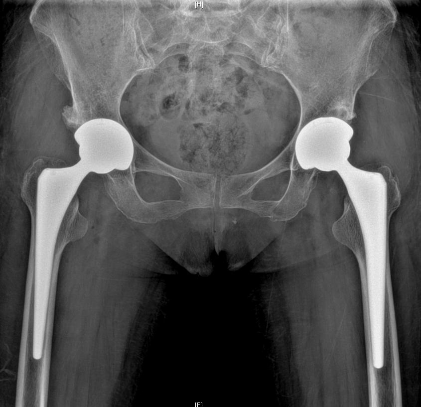 인공 고관절 부품 구성