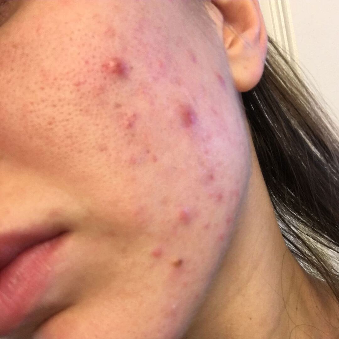 화농성여드름 발생 원인과 관리 방법을 설명하는 피부 관리 정보 이미지로 모공 속 염증 형성 과정과 재발 방지를 위한 생활습관 개선 포인트를 담은 스킨케어 가이드 자료