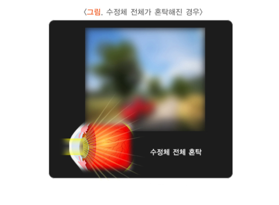 백내장 증상, 백내장 수술비용, 백내장 수술후 시력회복 기간 4. 시력감퇴