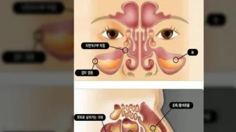축농증 증상 치료방법 원인 으로_12