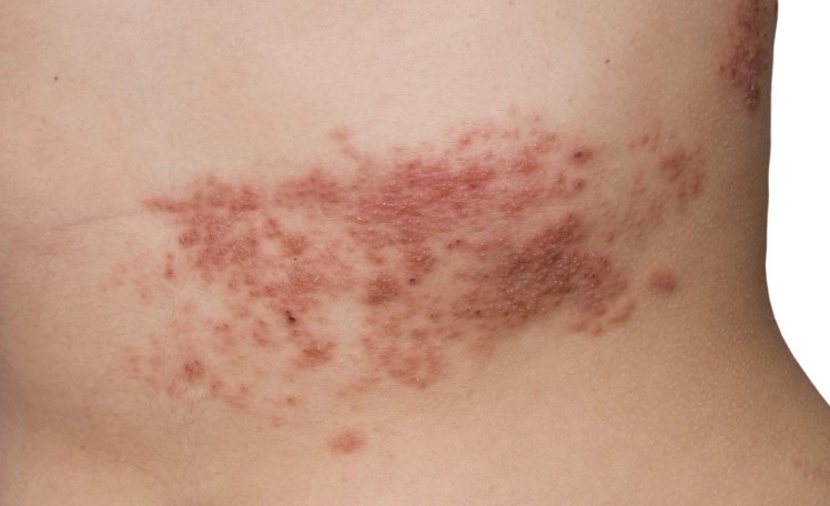 대상포진 초기증상 4가지 및 대상포진 전염성과 병원 예방접종 가격 정리