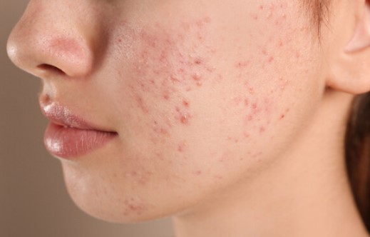 여드름 없애는법 여드름 종류 부위별 원인 정리