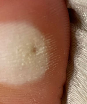 티눈 밴드 사용 후기 - 티눈 제거 완료