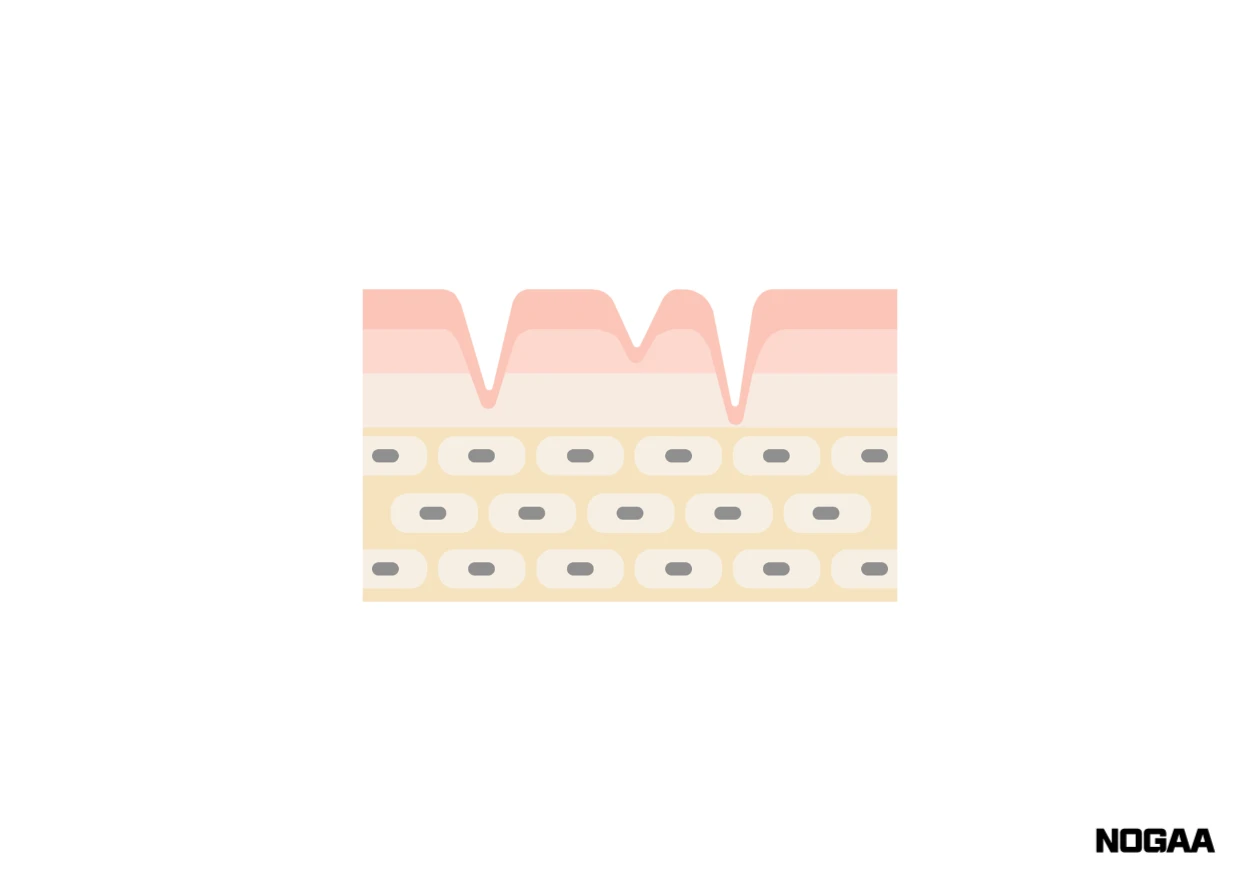 모공각화증 치료 방법