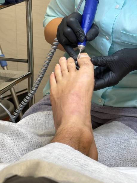 발톱무좀을 치료하기 위해 발톱을 갈아내는 사진