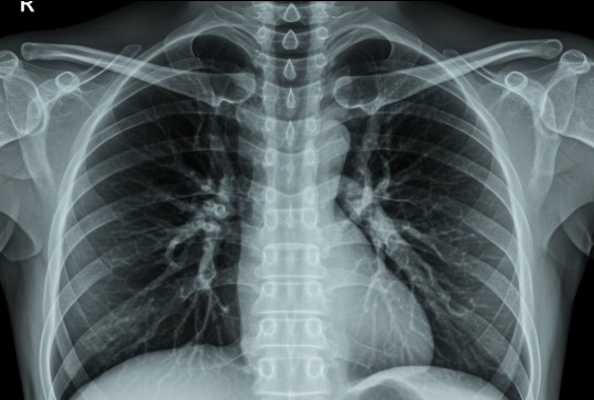 폐 건강 지키기(호흡법, 미세먼지, 식습관)