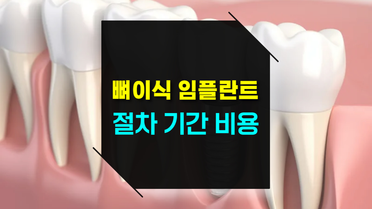 뼈 이식이 필요한 임플란트 시술: 절차, 기간, 비용