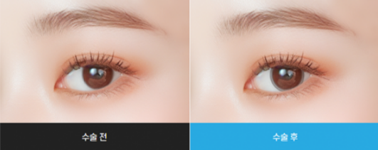 아이링수술, 아이링수술후기, 써클렌즈 대체, 눈동자확대수술, 미용성형, 안과 시술, 렌즈부작용