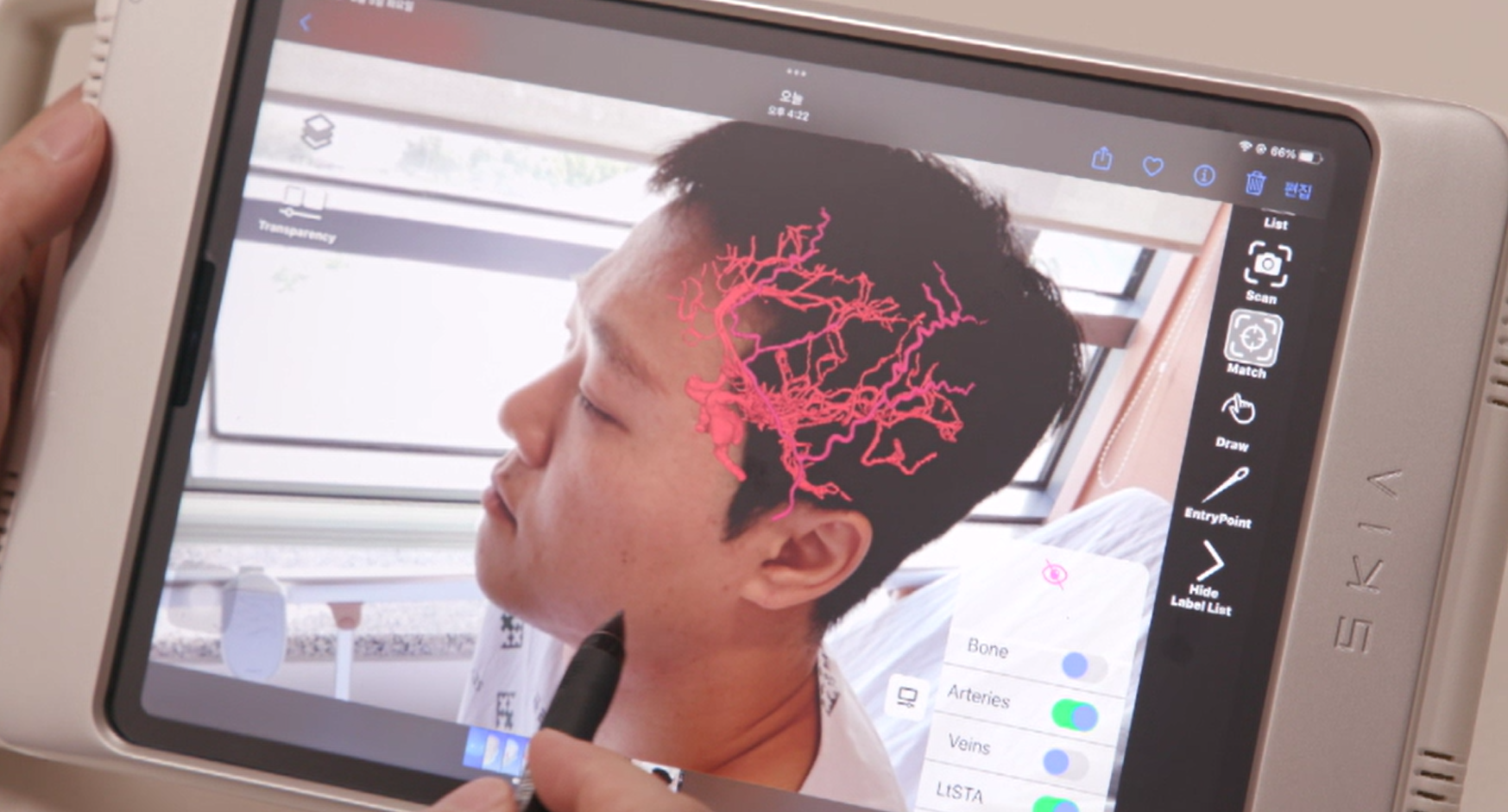 명의 뇌 뇌동맥류