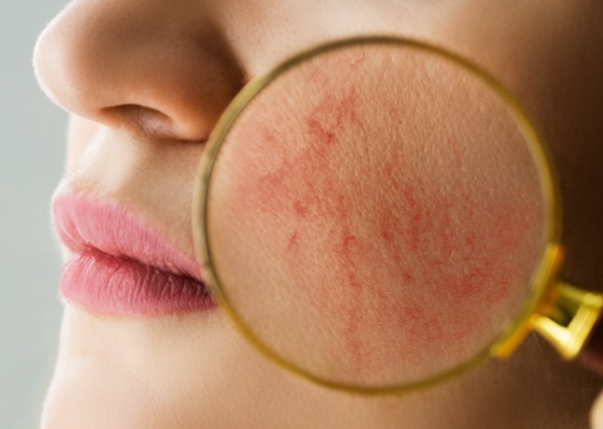 안면홍조증을 완화하는 가장 효과적인 생활 습관