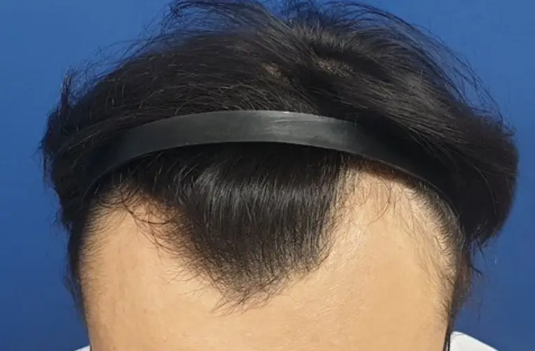 탈모유형