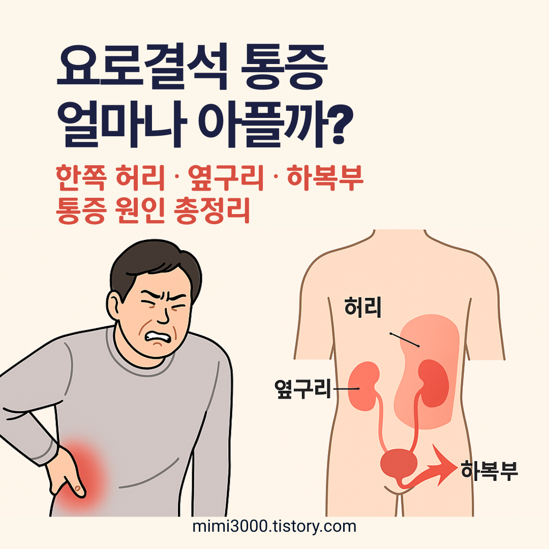 요로결석 통증 강도와 위치 등통증, 한쪽 허리, 옆구리, 하복부 아픈 원인 총정리