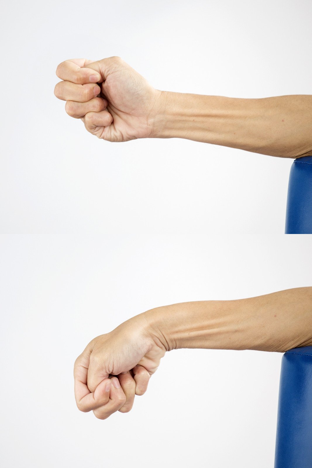 척골 신경 이전술