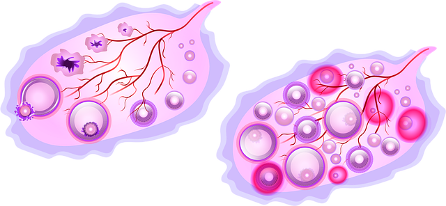 다낭성난소증후군 난포