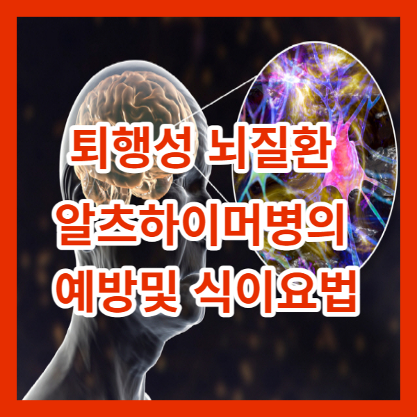 퇴행성 뇌질환 알츠하이머병의 예방및 식이요법